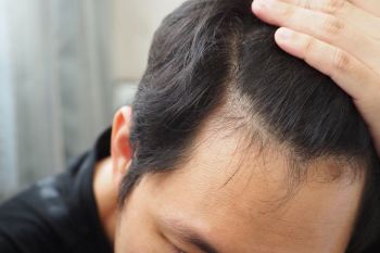 Transplante capilar: 5 perguntas para entender o procedimento