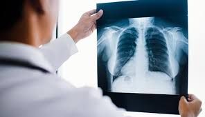 Condição pulmonar em novela expõe desafios com doenças raras no Brasil