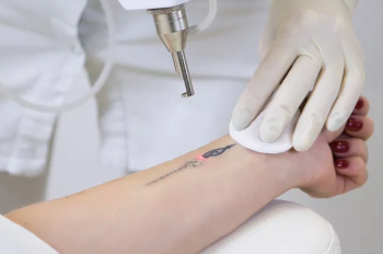 Procura por remoção de tatuagens cresce e revela novas formas de relação com a imagem pessoal