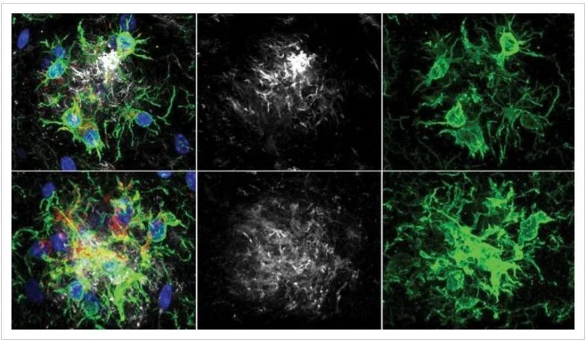 Pesquisadores descobrem maneira de retardar perda de memória no Alzheimer