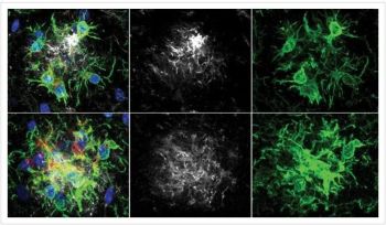 Pesquisadores descobrem maneira de retardar perda de memória no Alzheimer