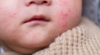 Dia Mundial da Alergia: 8 de julho alerta para sinais e cuidados com reações alérgicas na infância